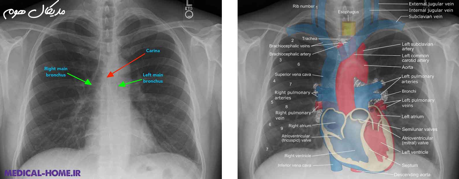 عکس رادیولوژی از قفسه سینه جهت بررسی قلب