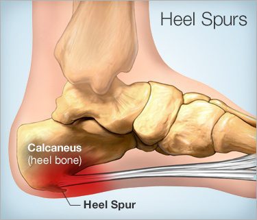 فشار خارپاشنه به تاندون پا و ایجاد درد شدید به کف پا