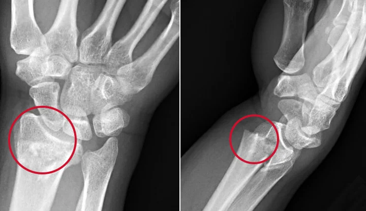 در این تصویر از دو زاویه از عکس رادیولوژی مچ دست، شکستگی استخوان مشاهده می شود