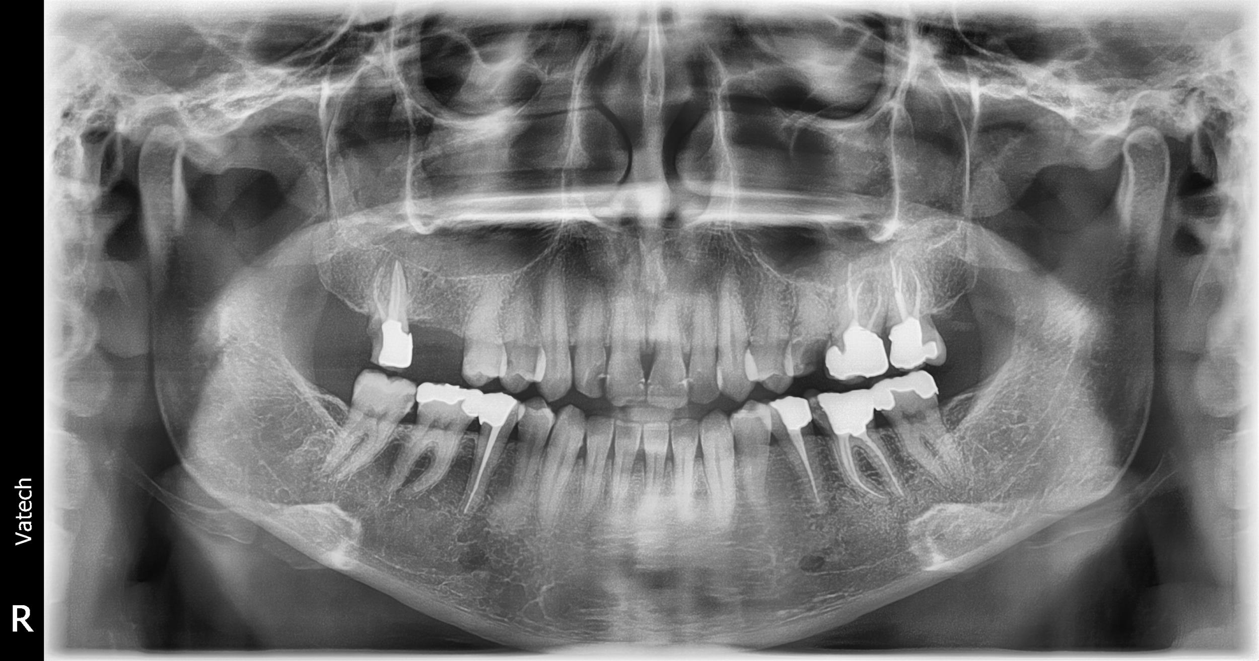 عکس دندان OPG با بیمه تکمیلی